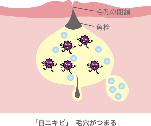 「白ニキビ」 毛穴がつまる