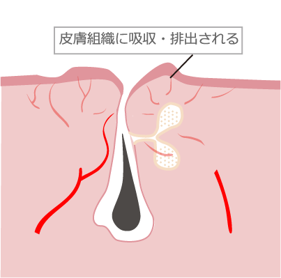 ニキビ跡の赤みとIPL治療
